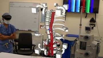 Orthopedic Spine Model in Augmented Reality with the Radha app!