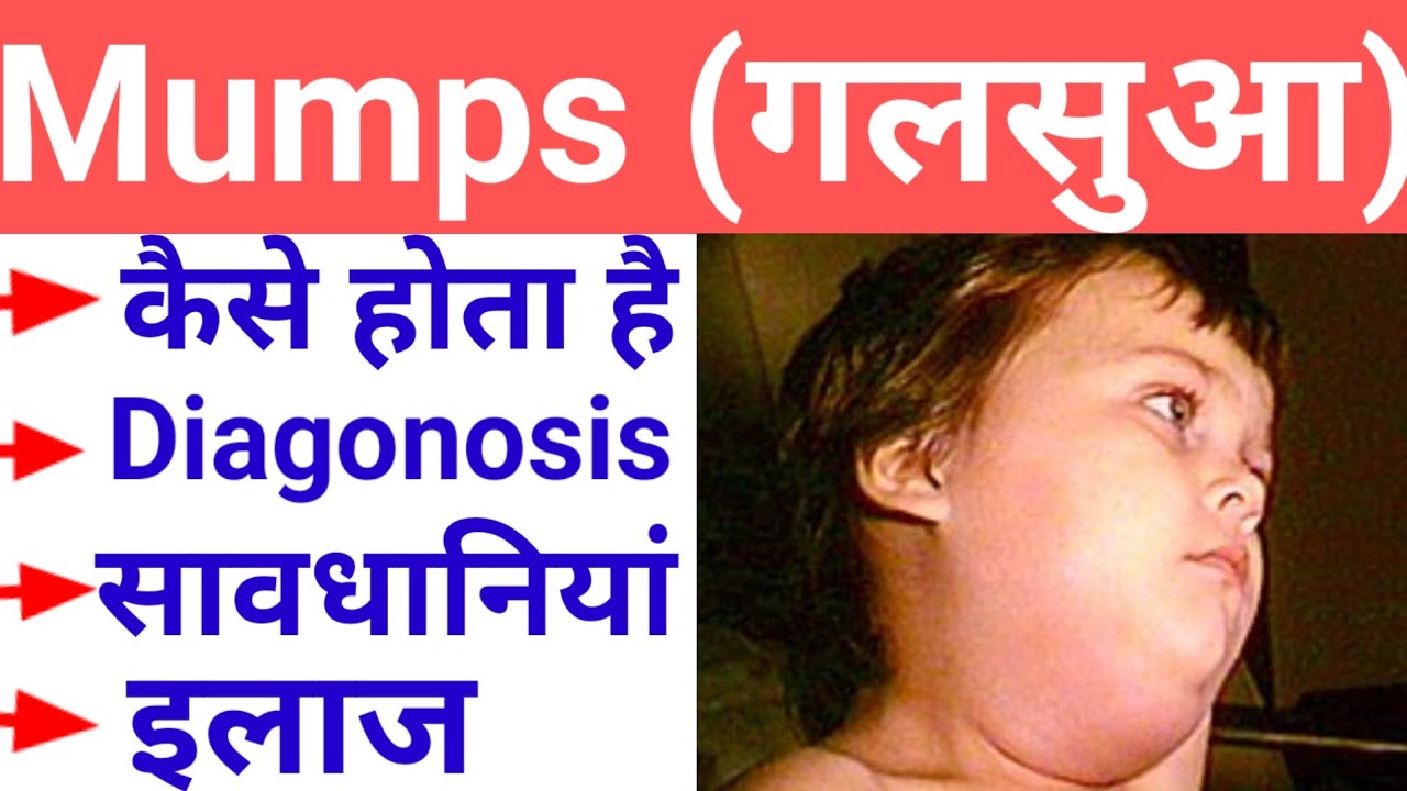 Mumps in hindi , symptoms of mumps, treatment of mumps, Diagnosis of