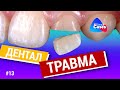 Дентальная травма. Дентал кейсы от BG #13