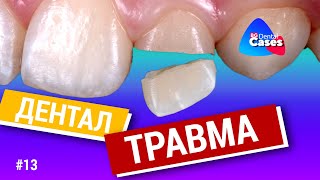 видео: Дентальная травма. Дентал кейсы от BG #13 картинка: Дентальная травма. Дентал кейсы от BG #13