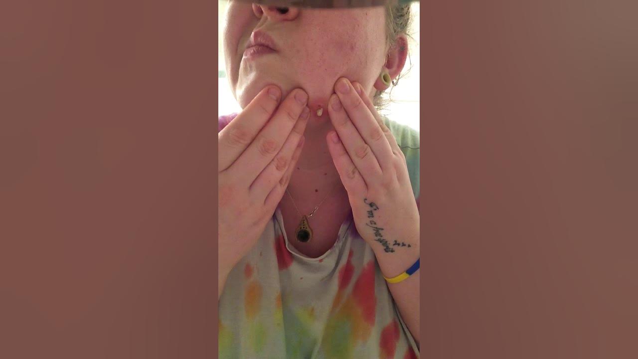 DENTAL ABSCESS getting bigger, this is the 6th time I’ve had to pop it