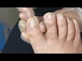 Pedicure Tutorial : Fungal toenail treatment &amp; Ingrown toenail removal. Nails care.