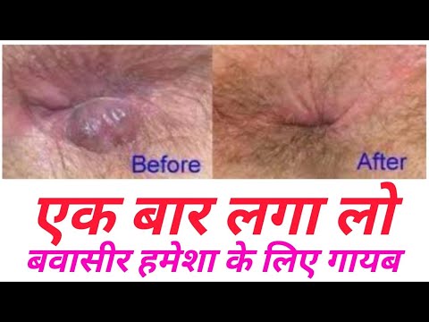 बवासीर का घरेलू नुस्खा । How To Cure Piles in Hindi By BITE OF HEALTH