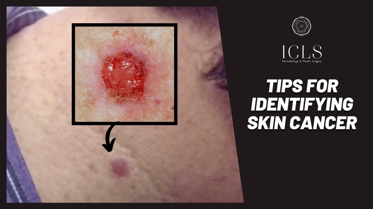 Skin Cancer Treatment Basal Cell Carcinoma Icls Dermatology