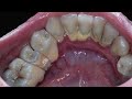 18yo. Female. SCALING | Dentist | Dokter Gigi Tri Putra