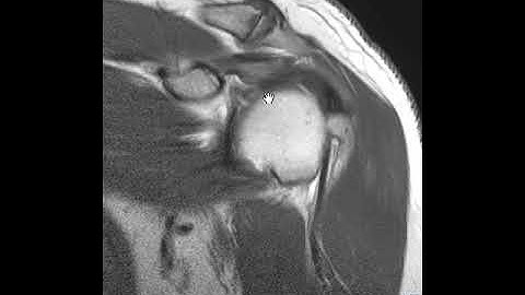 Labral tear of shoulder on ABER images