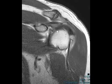Labral tear of shoulder on ABER images - YouTube