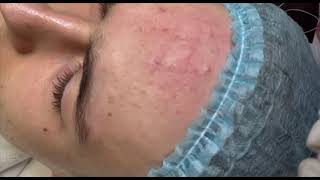 Professional face cleaning. Removal of pimples. Làm sạch mặt chuyên nghiệp. Loại bỏ mụn nhọt.