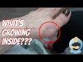 REMOVAL OF A BIG GANGLION CYST!!!  FLUID DRAINED FOR PAIN RELIEF OF INFLAMED FOOT