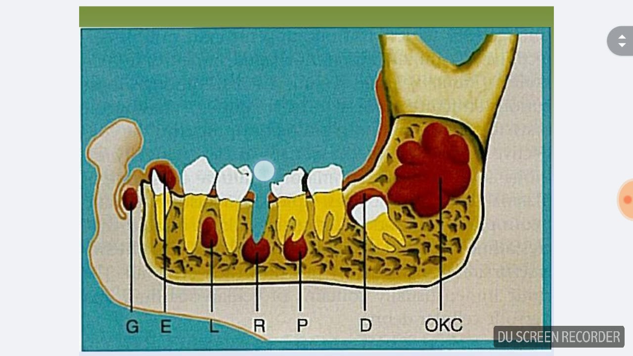 Cysts Of The Oral Cavity  Intro Lecture  1 Of 3