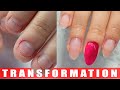 Extremely Bitten Nails PART 3! 😱 INCREDIBLE Transformation On Bitten Nails | A Nail Bitter's Journey