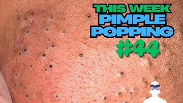 This Week in PIMPLE POPPING #44