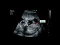 15 weeks active fetus  its a boy   by crl  ultrasound case
