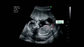 15 weeks active fetus | It's a Boy!!  | By CRL | Ultrasound Case