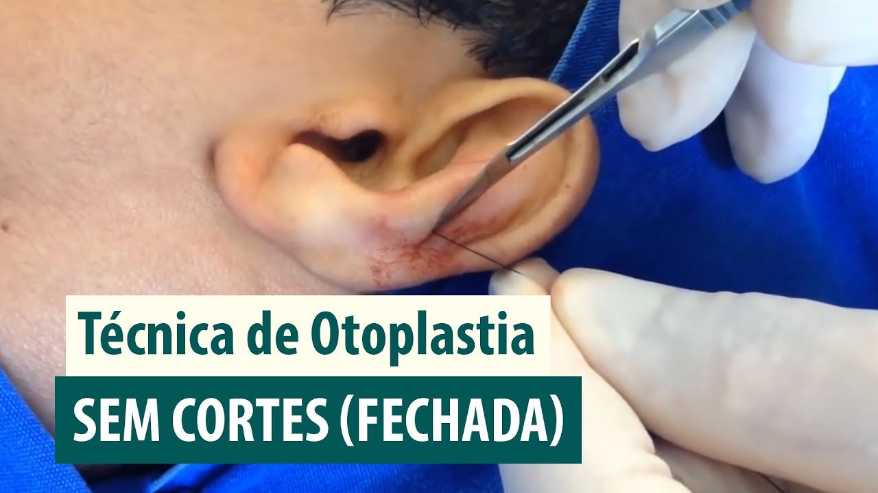 Aula de Técnica de Otoplastia Fechada com Fios e Sem Corte - Dr