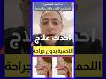 Shorts طرق إزالة لحمية الأنف بدون جراحة اهلا يا دكتور لحمية الأنف Shorts طرق إزالة لحمية الأنف بدون جراحة اهلا يا دكتور لحمية الأنف