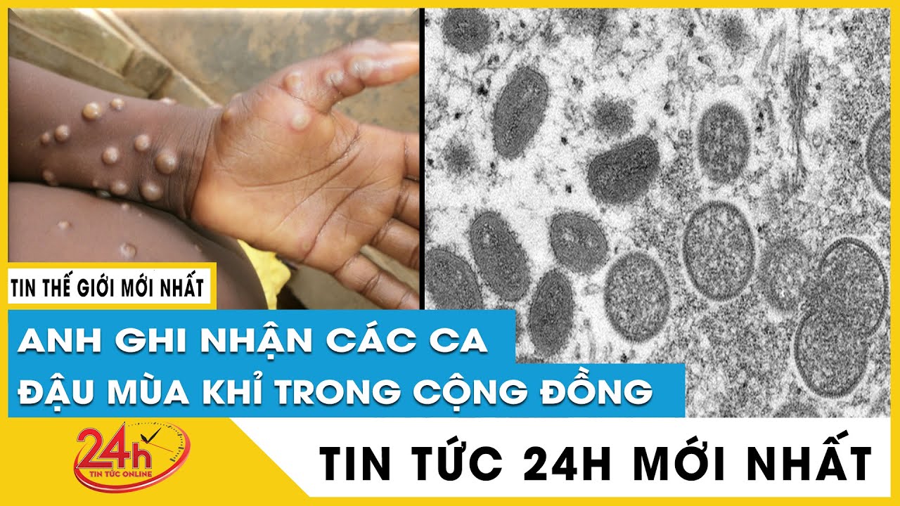 Bộ y tế hướng dẫn các biện pháp phòng, chống tạm thời với bệnh đậu mùa khỉ | TV24h