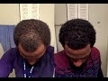 Rogaine Minoxidil Journey ( Week 10 )