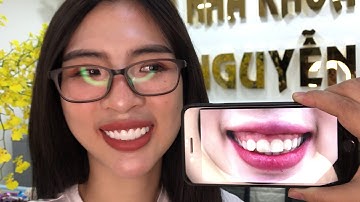 Nha khoa điều trị hở lợi số 1