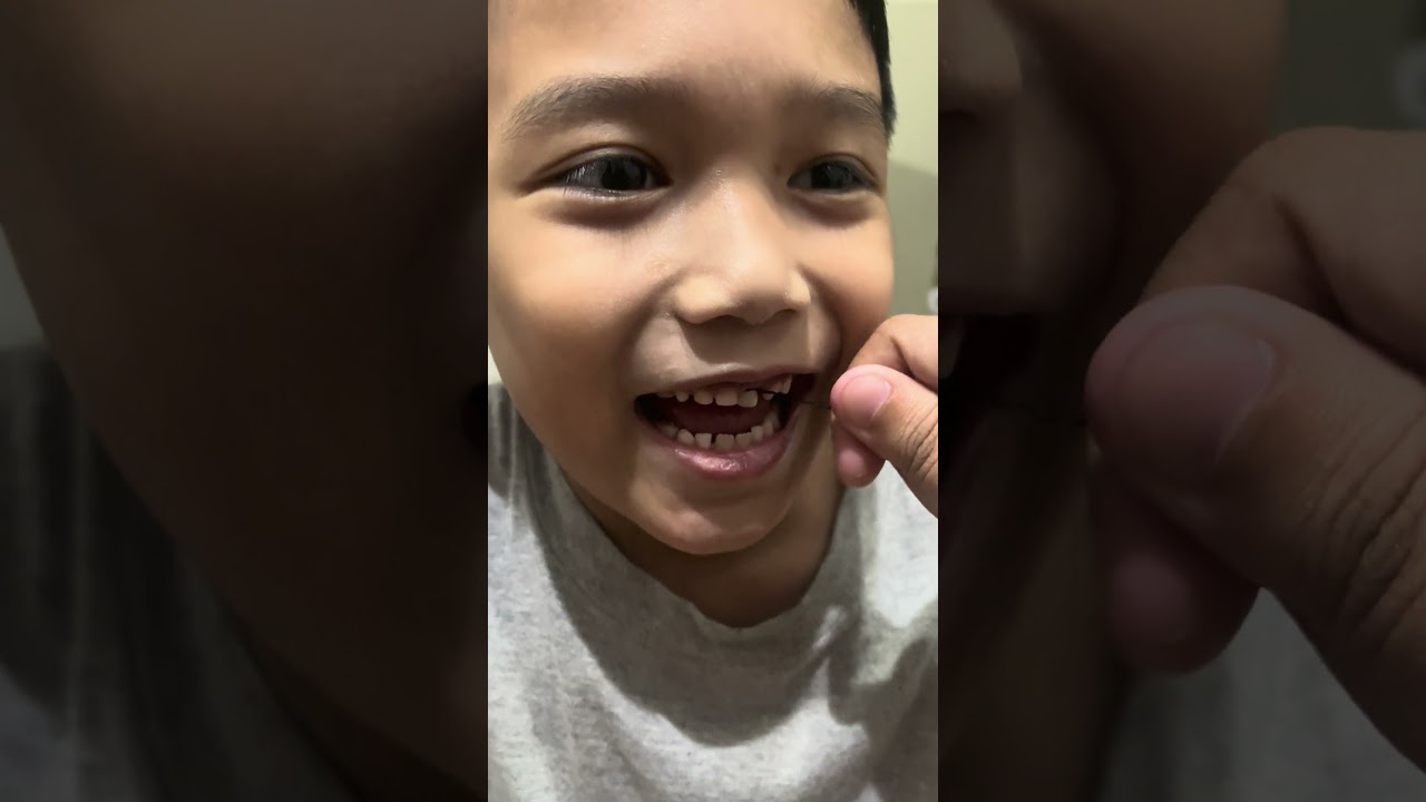 How to Safely Pull a Wiggly Tooth at Home