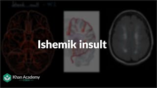 Ishemik insult | Insult | Tibbiyot