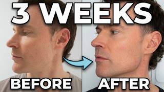 I Spent 10 Years Testing RF Skin Tightening - My Jowls Now