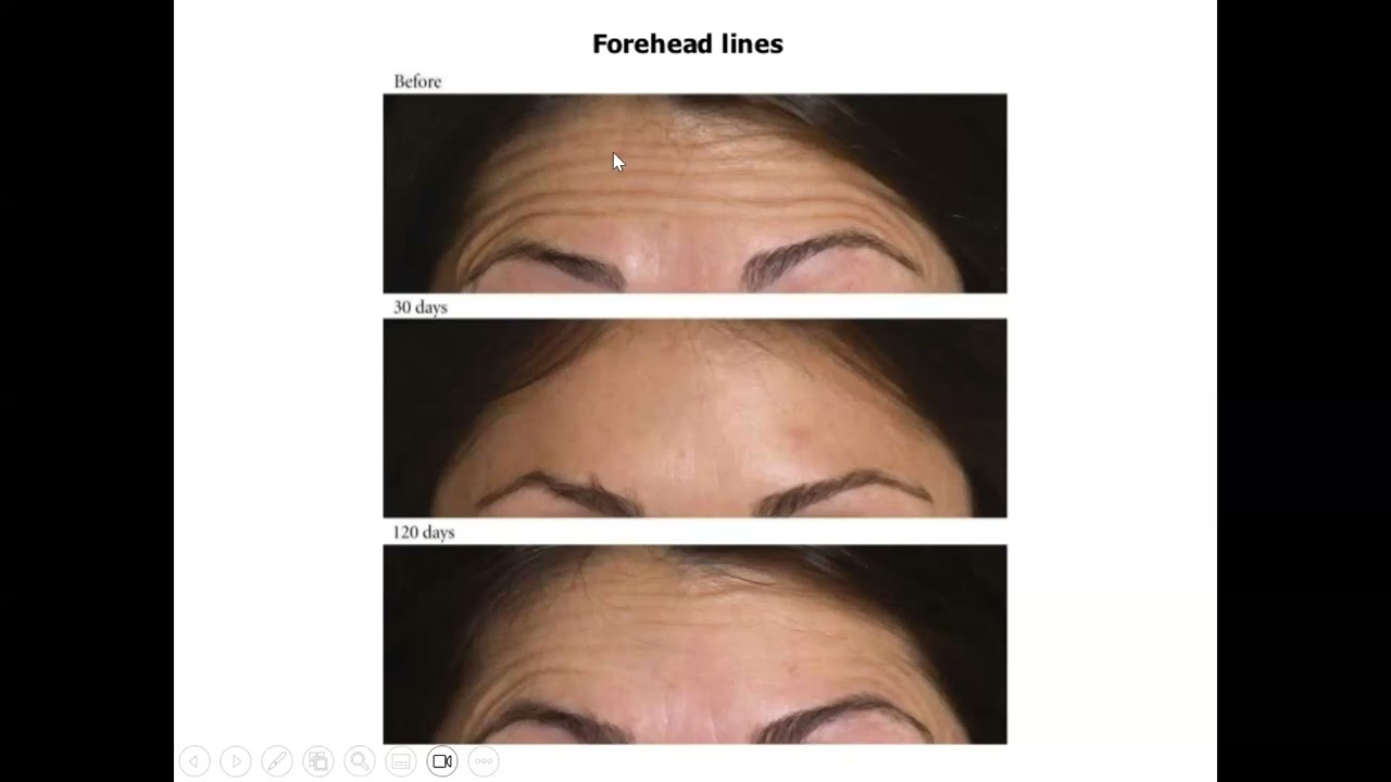 دبلوم التجميل الطبي الغير جراحي/ مادة تشريح الوجه / المحاضرة  2