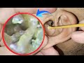 Horror: Clean dry earwax in the ear canal, infected ear canal | ASMR | EP 220