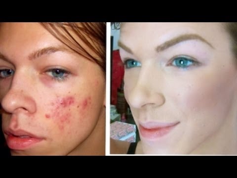 Online cheap minerals acne makeup bare