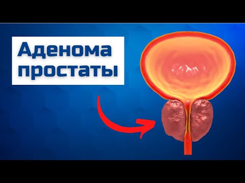 Гиперплазия простаты | Аденома предстательной железы | ДГПЖ