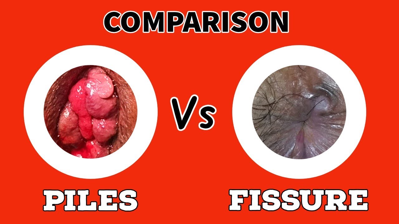 Comparison - PILES Vs FISSURE - ( English Language ) 