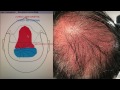 Dallas Crown Hair Transplant Recipient Site Design