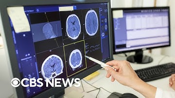 New study finds link between traumatic brain injuries and brain cancer risk