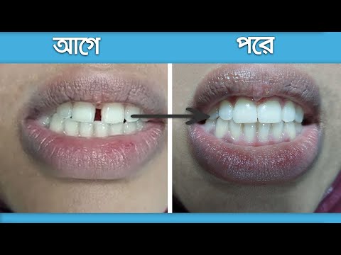 ভিডিও: ওজন কমানোর W টি উপায় (কিশোরী মেয়েদের জন্য)