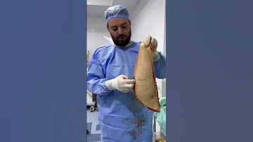 الجلد المزال من عملية شد البطن دكتور علي جابر شفط الدهون نحت الجسم 