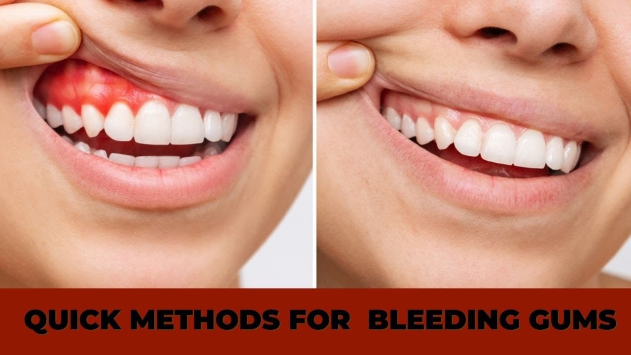 Say Goodbye to Bleeding Gums: 7 Quick and Effective Methods