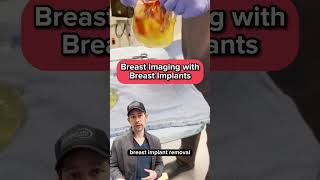 Breast Imaging with Breast Implants
