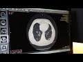 COVID Pozitif Hastanın Akciğer BT Görüntüsü