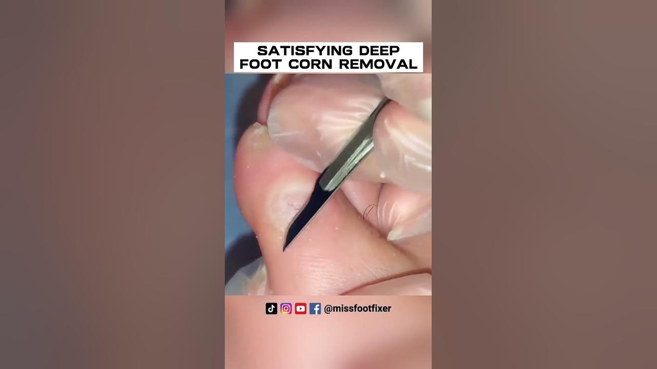 Satisfying Deep Foot Corn Removal By