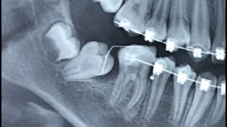 Disimpacting Molars Using The Bach Technique