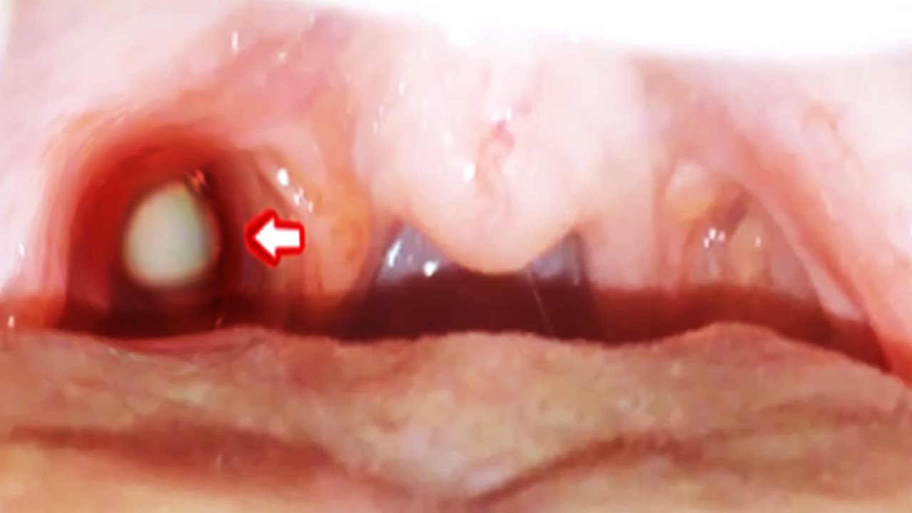 Worst Tonsil Stones Giant Tonsilloliths And Stone Removal Documentary