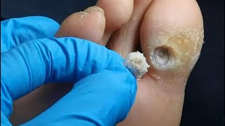Pedicure Tutorial: How to treat plantar wart. Plantar wart removal. A deep hole on the big toe.