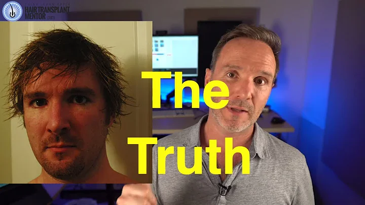 My 9 Hair Transplants -  The Truth