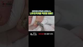 나무조각처럼 박리된 발톱!! 조각조각 제거하다!? 20대 여성 고객님의 스트레스 해소^^ #레푸스 #refuss #내성발톱 #무좀 #무좀발톱 #toenail #nail #발톱