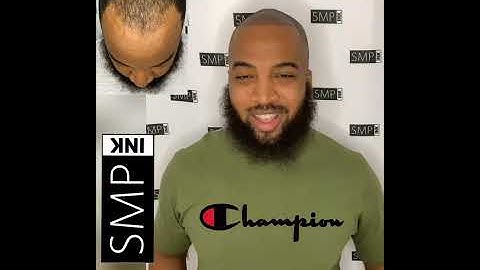 SMP Ink - Scalp Micropigmentation Testimonial