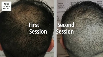 Scalp Micropigmentation SMP FUE Scar Camouflage & Crown Density