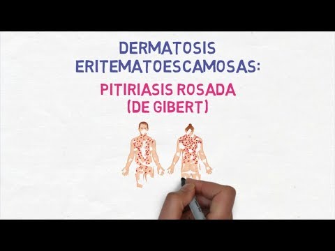 Vídeo: Pitiriasis Rosada (erupción Del árbol De Navidad): Imágenes, Causas