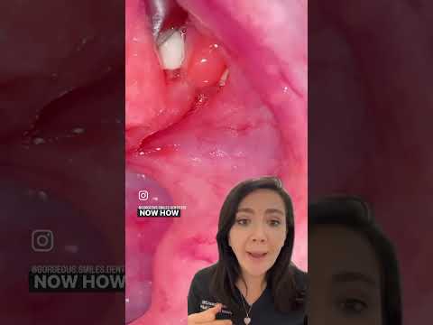 Tonsil Stones and how to avoid them !