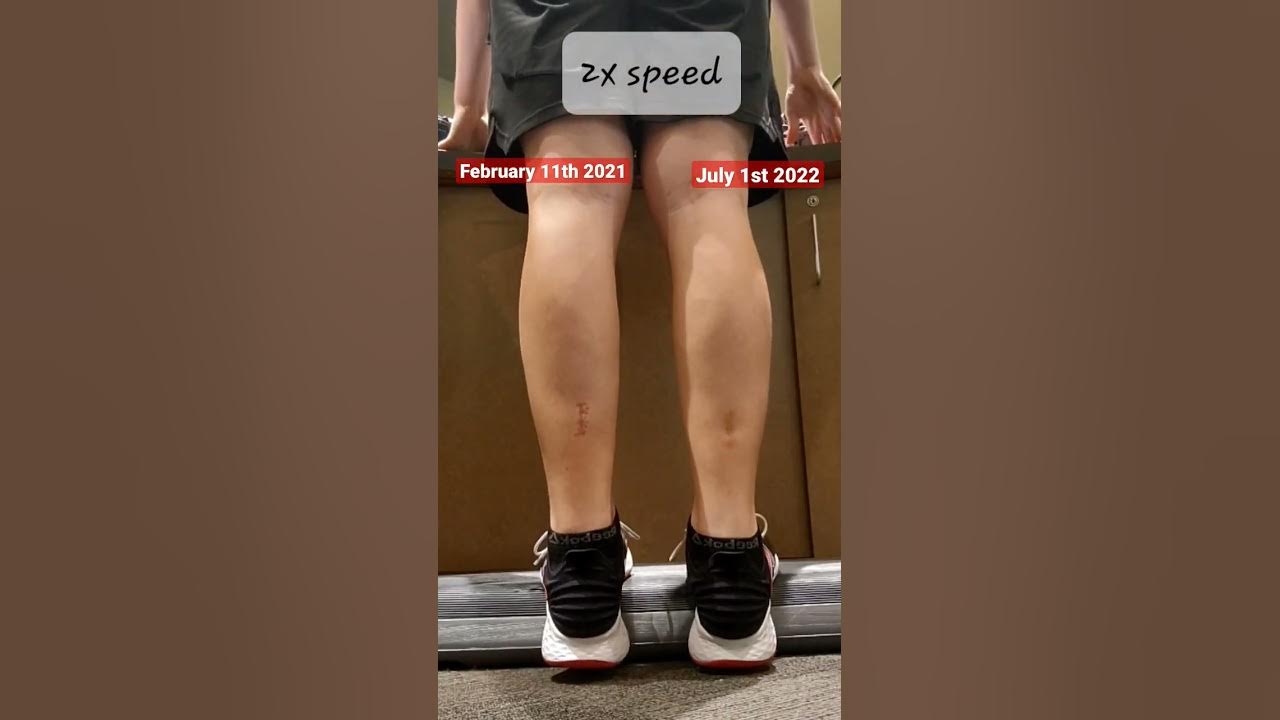 doctors-had-to-cut-my-calf-and-sew-it-back-gastrocnemius-recession