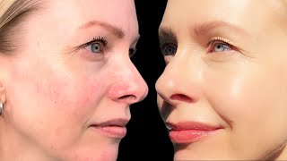 AZELAIC ACID  how to layer in your routine | it FIXED my ROSACEA !!